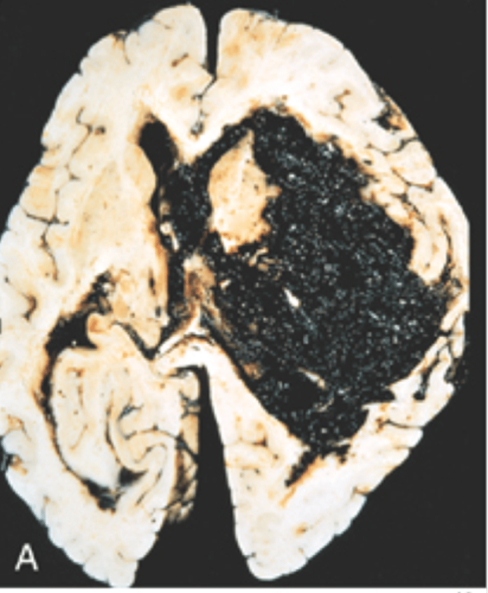 <p>Define Condition:</p><p>-Diastolic BP &gt; 130</p><p>-High ICP</p><p>-HA, confusion, vomiting, convulsions +/- coma &amp; death</p><p>Arterioles show fibrinoid necrosis</p><p>See hemorrhage in basal ganglia here</p>
