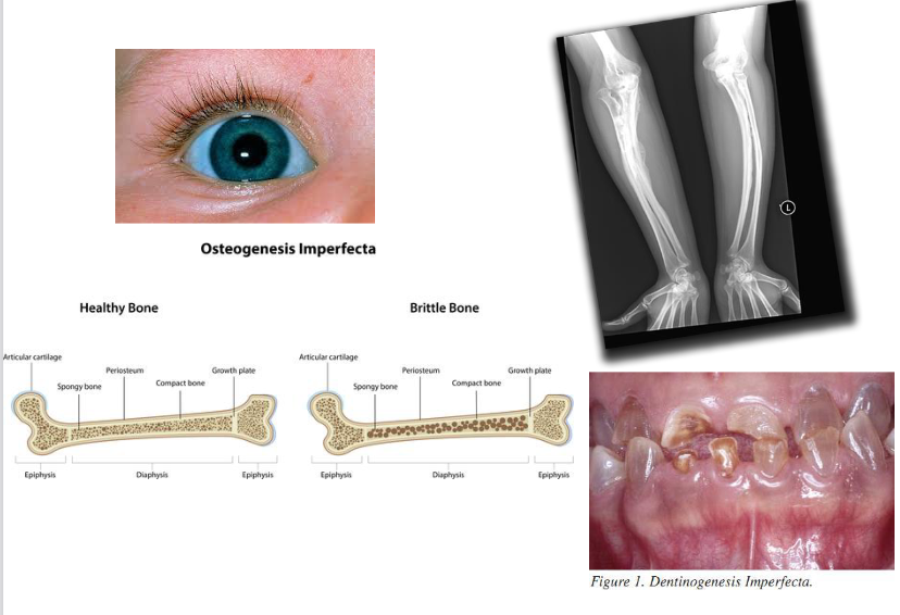 <p>= brittle bone disease = broze botteziekte</p><ul><li><p>groep van gerelateerde congenitale aandoeningen (6 verschillende types) waar collageen type I productie door osteoblasten verstoord is ten gevolge van genmutaties (hoeveelheid of samenstelling van type I collageen is afwijkend)</p></li><li><p>defecten leiden tot afwijkingen gekenmerkt door:</p><ul><li><p>enorme broosheid van beenderen</p></li><li><p>spontane fracturen van lange pijpbeenderen</p></li><li><p>skeletvergroeiingen (deformaties)</p></li><li><p>blauwe sclerae (thv de ogen)</p></li><li><p>doofheid</p></li><li><p>verstoorde tandontwikkeling (dentinogenesis imperfecta)</p></li></ul></li></ul><p></p>