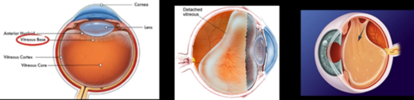 <p>posterior hyaloid still attached at either ONH or fovea (often ONH)</p>
