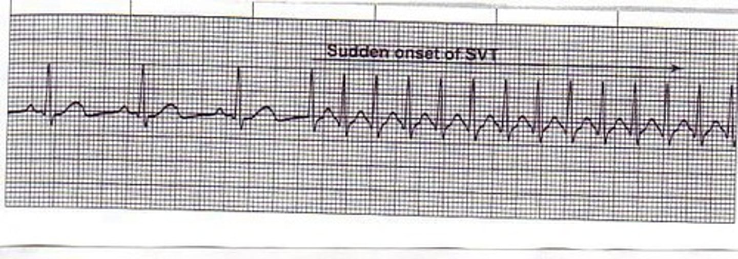 <p>Sudden burst of 3 or more PAC's that becomes the rhythm for a short time.</p>
