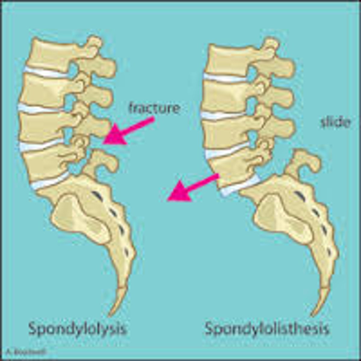 <p>forward slipping of one vertebra over another</p>