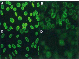 <ol start="185"><li><p>Which of these ANA patterns would be associated with high titers of antibodies to the Sm antigen?</p></li></ol><p>a) image A</p><p>b) image B</p><p>c) image C</p><p>d) image D</p><p></p>