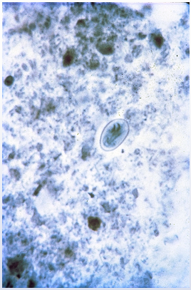 <p>chronic intermittent nonbloody diarrhea, hx drinking untreated freshwater</p>