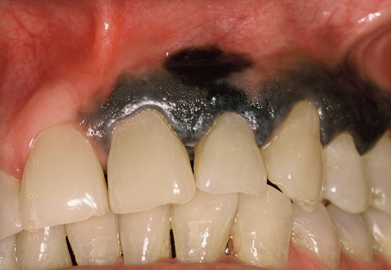 <p>Case 10. A 62 year old male with a painful dark lesion on the maxillary gingiva that has increased in size the past few months. 10a. What is the most likely diagnosis?</p>