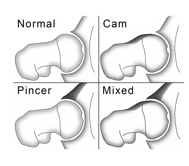 <ul><li><p>Bony abnormalities</p><ul><li><p>CAM: head/neck of femur</p></li><li><p>Pincer: acetabulum</p></li><li><p>Mixed: both</p></li></ul></li><li><p>Pain Patterns</p><ul><li><p>FABER: flexion, abduction, and ER</p></li><li><p>FADIR: flexion, adduction, and IR</p></li></ul></li><li><p>Causes: inflexibility and hypomobility or hypermobility</p></li><li><p>Labral tears: catching or clunking sensation</p></li></ul><p></p>