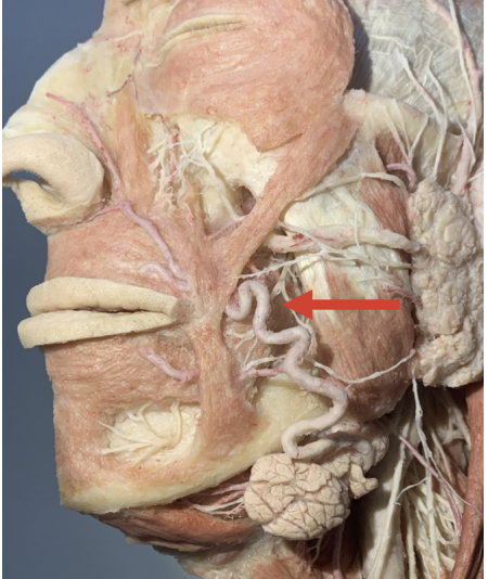 <p>Which fascial space is marked by the red arrow?</p>
