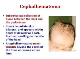 <p>Collection of blood that forms under the periosteum (scalp membrane) of a newborn’s skull, typically caused by pressure and shear forces during a difficult birth, raised bulge that does not cross the cranial suture lines, generally harmless and resolve on their own within weeks to months but some can calcify which would require medical attention </p>