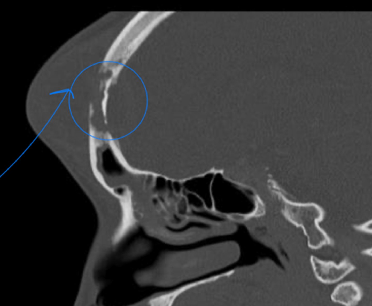 <p>pott puffy tumor → frontal bone osteomyelitis assoc. with subperiosteal abscess</p>