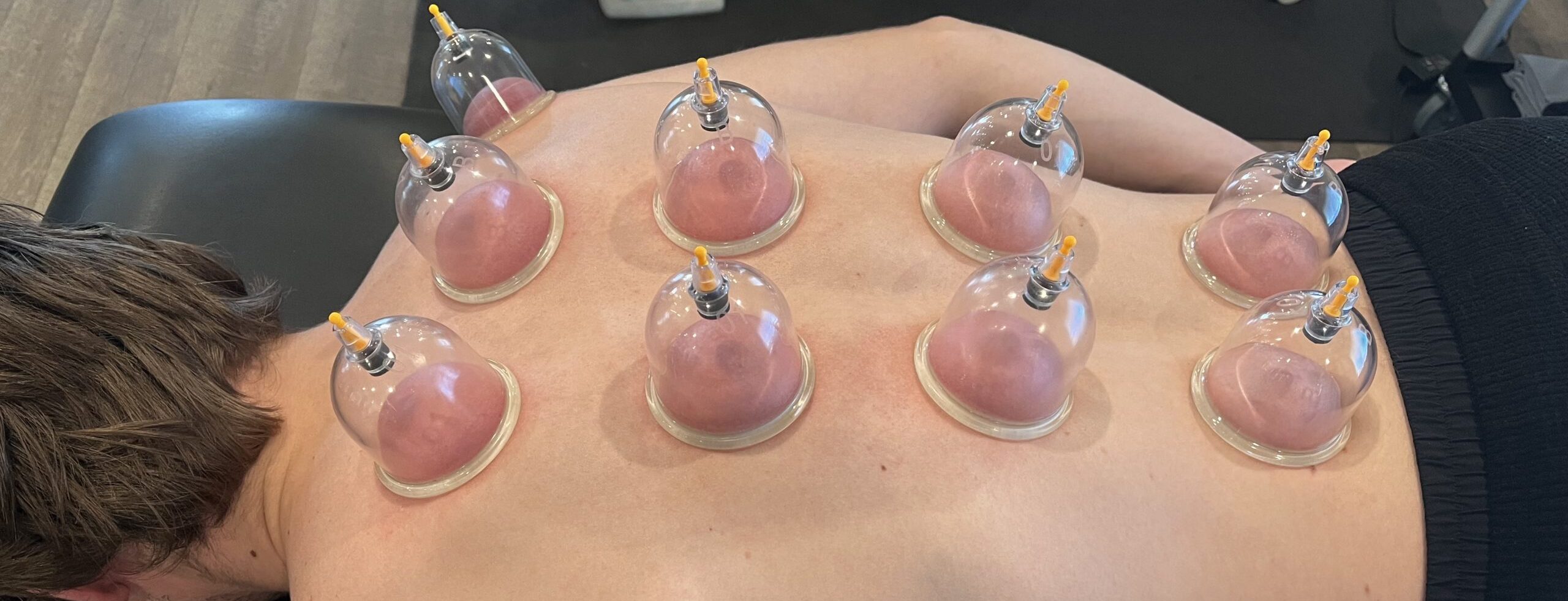 <p>A cultural therapy where heated cups are placed on the skin, leaving circular erythematous or bruised marks</p>