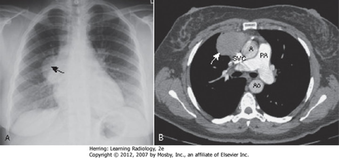 <p><span style="text-decoration:underline">Define Condition</span>:</p><p><strong><em>Tumor originating from epithelial cells of thymus that may be benign OR malignant (carcinoma)</em></strong></p><p>-<span style="text-decoration:underline">Hx</span>:</p><p>&gt; Associated Autoimmune Disorder (MG, Pure Red Cell Aplasia)</p><p>-<span style="text-decoration:underline">Sx/PE</span>: <strong><em>D/t Compression of organs</em></strong></p><p>&gt; SVC Syndrome</p><p>&gt; Dysphagia</p><p>&gt; Cough</p><p>&gt; Chest Pain</p><p>-<span style="text-decoration:underline">Dx</span>: <strong><em>MG</em></strong></p><p>&gt; Benign, Well-Differentiated &amp; Encapsulated (can be REMOVED)</p>