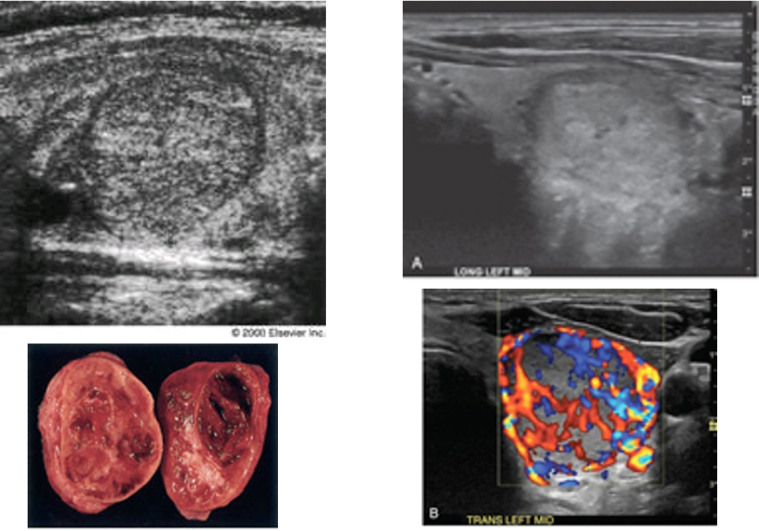 <p>irregular margins</p><p>thick irregular ‘halo’</p><p>nodular enlargement</p><p>(must use histology NOT FNA)</p>