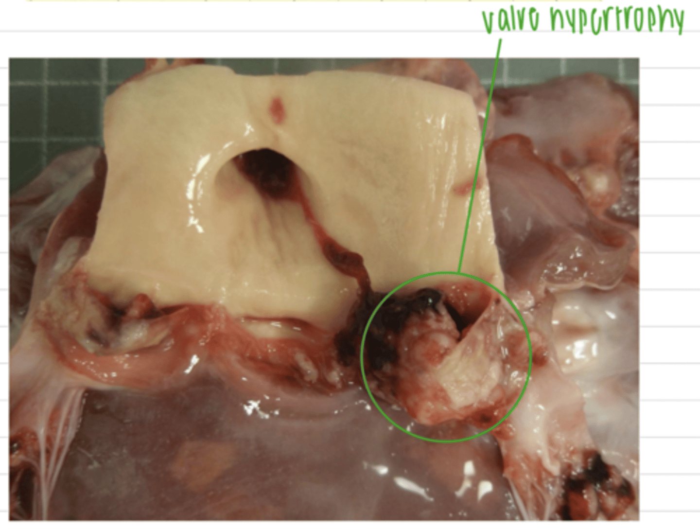 <p>hypertrophy of the cardiac muscle so that it can pump harder and/or hypertrophy of the valve</p>