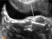 <ol><li><p>The femur is at a shortened length in this image. What is that referred to as?</p></li><li><p>This finding can be associated with what pathology?</p></li></ol><p></p>