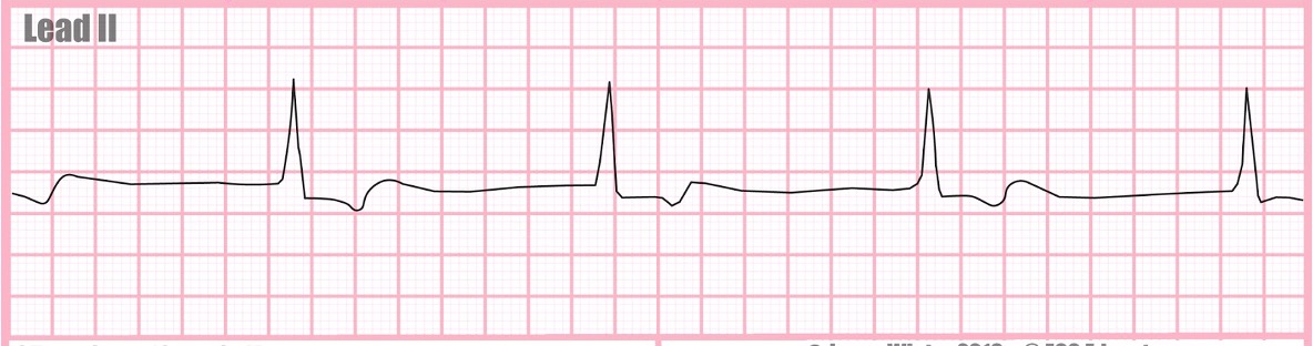 <p>HR: 40-60 bpm</p><p>P-wave: absent</p><p>Regularity: Regular</p><p>PR Interval: Absent</p><p>QRS Duration: Normal</p><p></p>