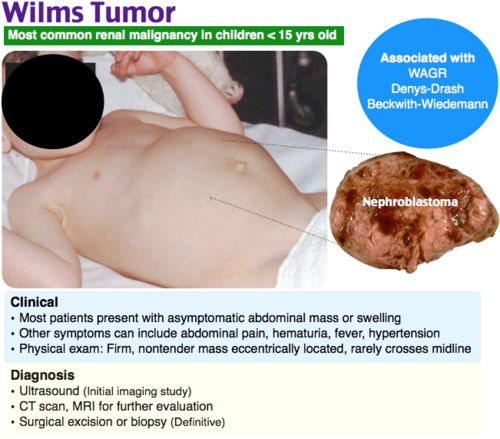 -abdominal swelling or mass w/o other symptoms- rarely crosses midline
-abdominal pain
-hematuria
-HTN
-may have subcapsular hemorrhage (fever, rapid abd enlargement, anemia, HTN)