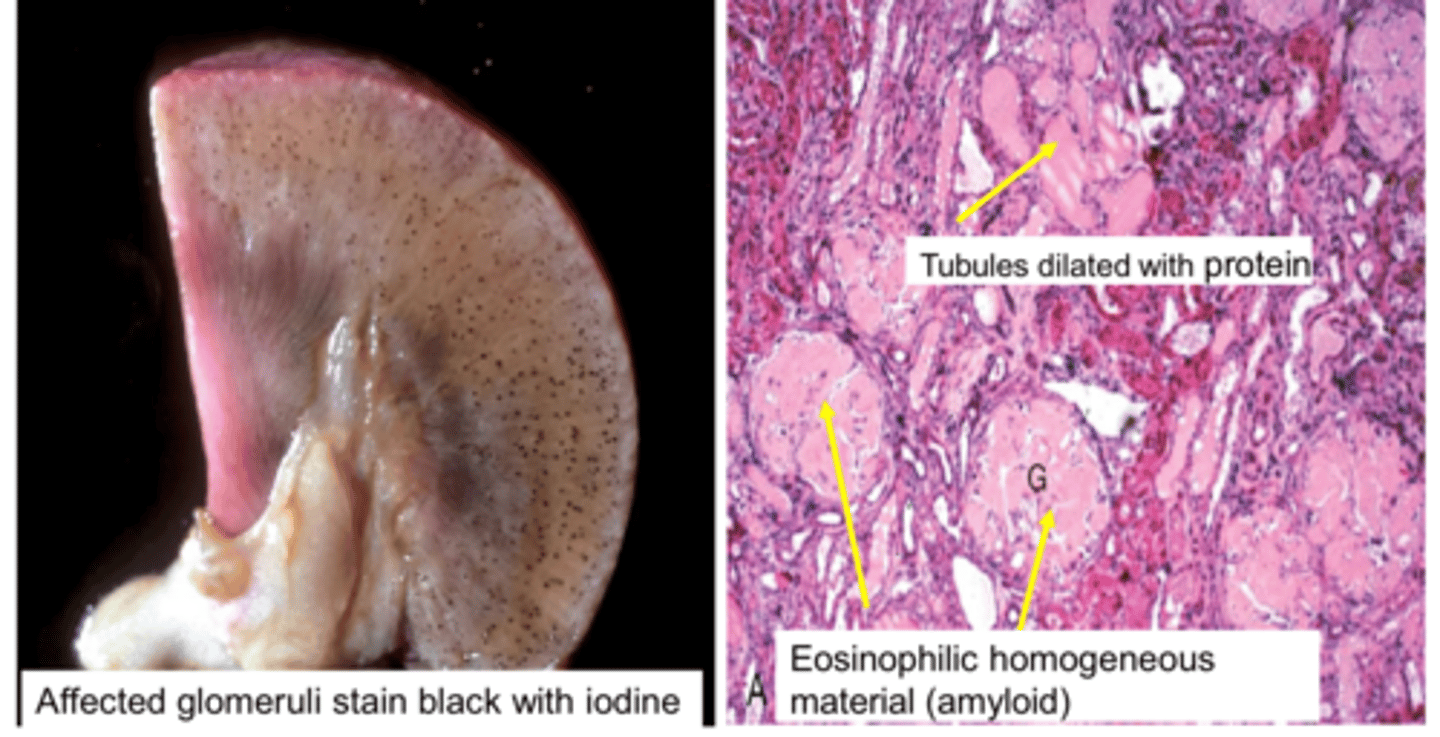 <p>Accumulation of insoluble extracellular protein</p><p>Most cases occur secondary to chronic inflammation</p><p>Affected glomeruli stain black with iodine on gross pathology</p><p>Tubules dilated with protein &amp; eosinophilic homogenous material show on microscopic pathology</p>