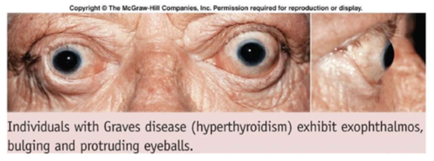 <p>grave's disease (autoimmune), thyroid tumors that cause hypermetabolism, toxic goiter, exophthalamos</p>