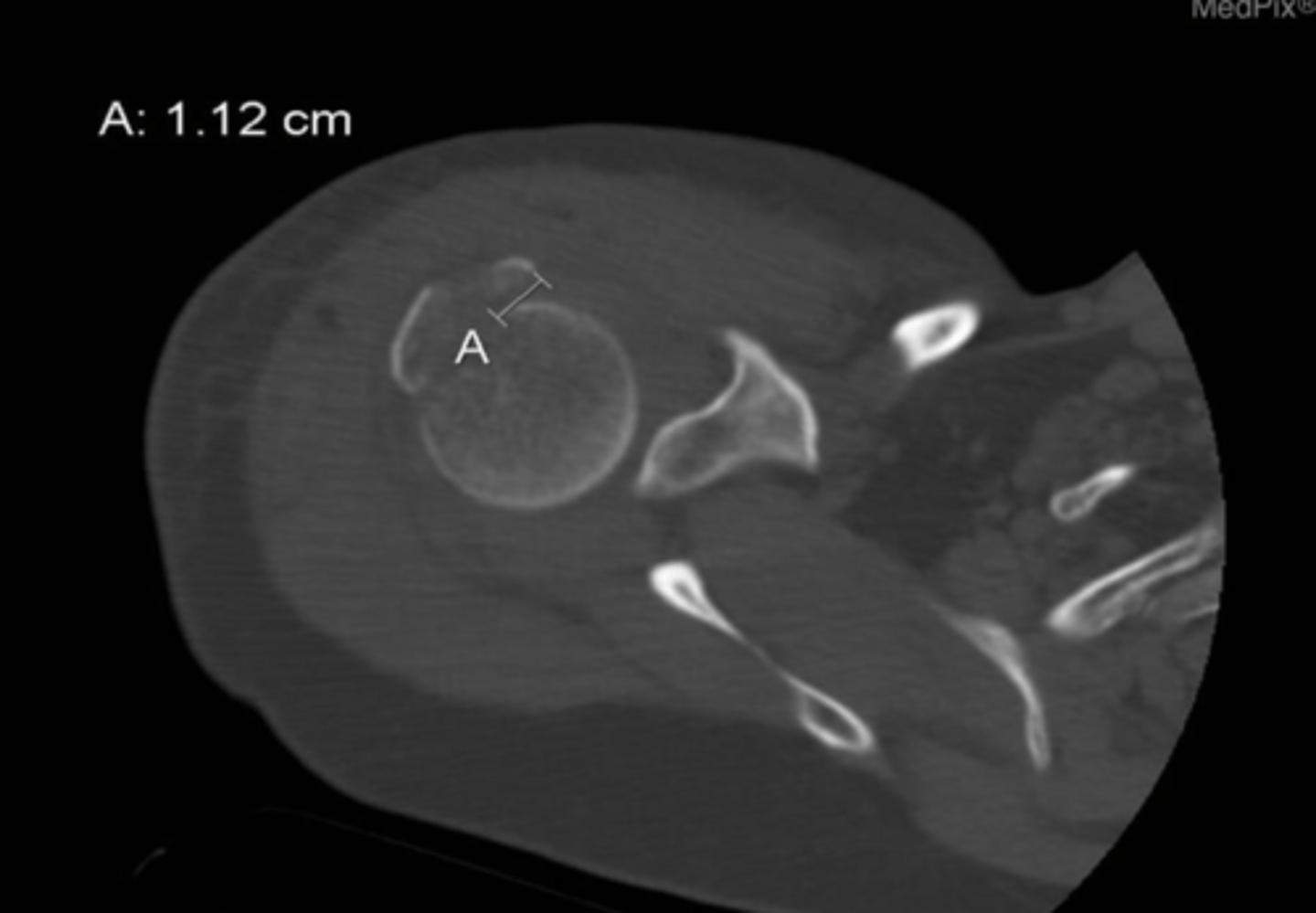 <p>What is identified by A in this image?</p><p>a. edema</p><p>b. displacement</p><p>c. bruising</p><p>d. osteophyte</p>
