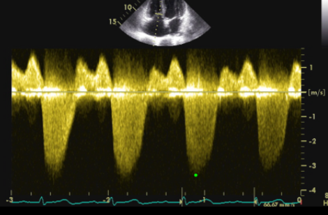 <p>Identify the spectral Doppler waveform:</p>