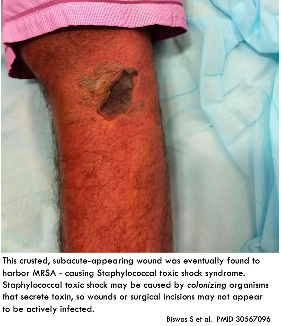 <p><strong><u>Symptoms of </u><mark data-color="purple" style="background-color: purple; color: inherit"><u>Streptococcal Infection:</u></mark></strong></p><ul><li><p><strong><mark data-color="red" style="background-color: red; color: inherit">Skin peeling (especially on palms and soles)</mark></strong></p></li><li><p><strong><mark data-color="red" style="background-color: red; color: inherit">Red eyes, lips, or tongue / Sunburn-like rash</mark></strong></p></li><li><p><strong><mark data-color="red" style="background-color: red; color: inherit">Sudden high fever (&gt;38.9°C) / Flu-like symptoms / Nausea and/or vomiting</mark></strong></p></li><li><p><strong><mark data-color="red" style="background-color: red; color: inherit">Hypotension / Fainting / Dizziness / Confusion</mark></strong></p></li><li><p><strong><mark data-color="red" style="background-color: red; color: inherit">Diarrhoea</mark></strong></p></li></ul><p></p>