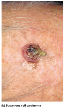 <p>Squamous cell carcinoma</p>