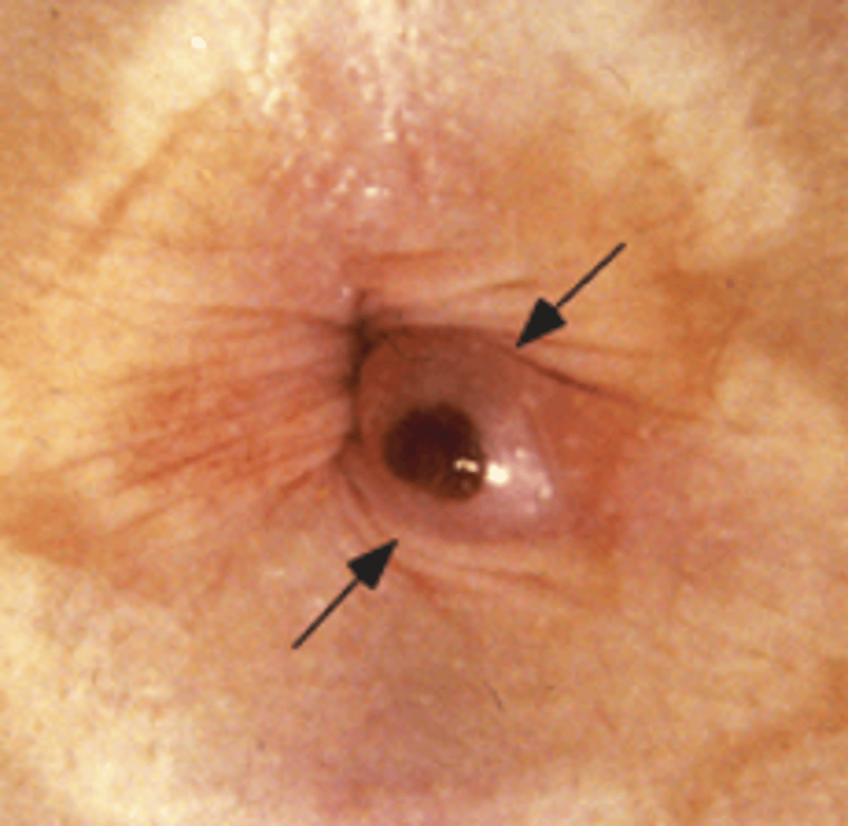 <p>A pt presents with <strong>protrusion and severe pain</strong> → <strong>thrombosed</strong>. Upon PE you see the image attached. If the diagnosis is clinical --- what is the likely dx?</p>