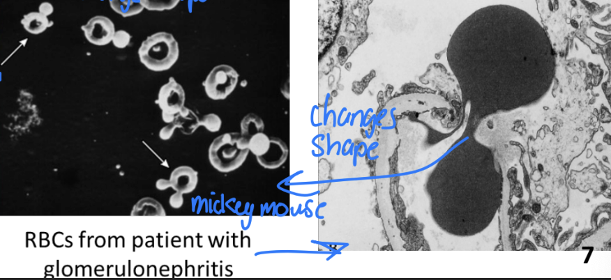 <ul><li><p>Blood can come from anywhere in urinary tract</p><ul><li><p>May indicate urological OR renal disorders </p></li></ul></li><li><p><span style="color: red;"><strong>________________ </strong></span>usually indicates <strong>physical disruption to filtration membrane</strong></p></li><li><p>RBC fragments isolated from urinary casts often have abnormal shape</p></li></ul><p></p>