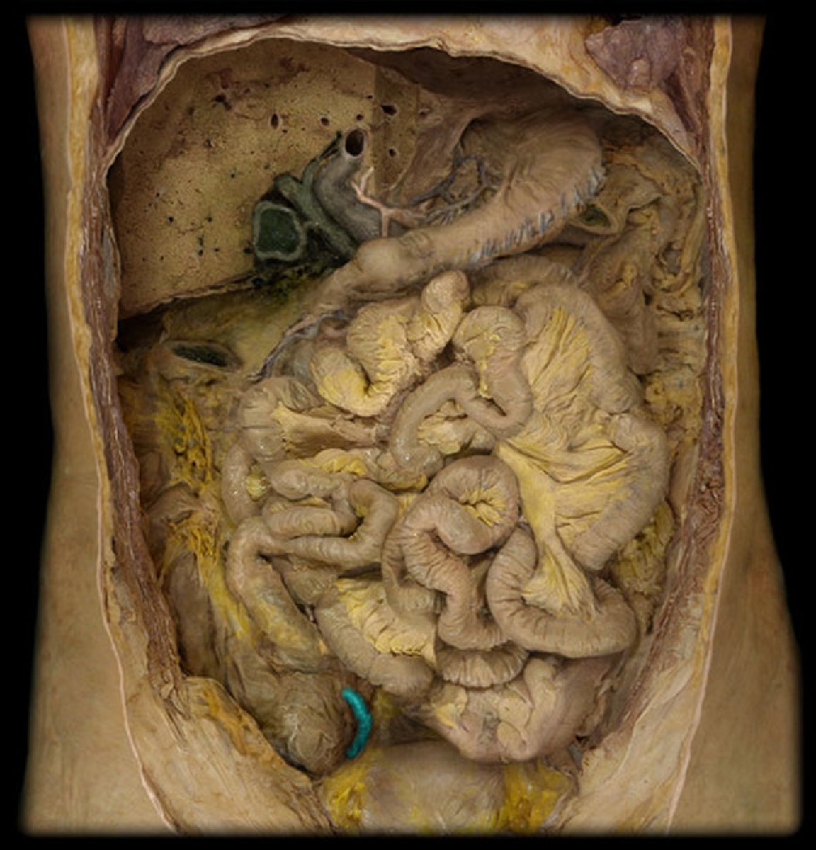 <p>Worm</p><p>- Between ileum and cecum</p><p>- Yellow</p><p>- Attached to the cecum</p>