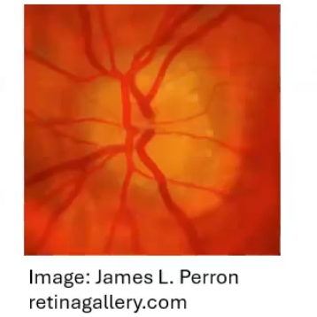 <p>papilloedema vs optic disc drusen</p>