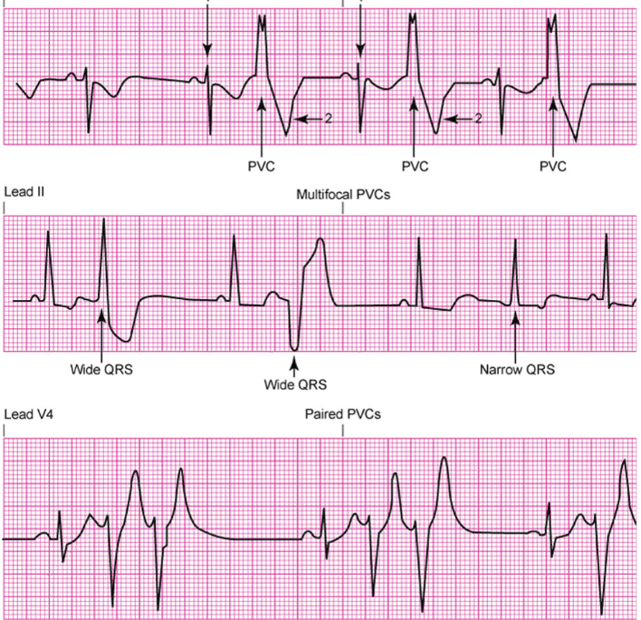 <p><strong>Causes:</strong></p><ul><li><p class="">Cardiac ischemia or infarction, tissue hypoxia</p></li><li><p class="">Anxiety, stress</p></li><li><p class="">Caffeine, nicotine, alcohol</p></li><li><p class="">Increased cardiac workload</p></li><li><p class="">Electrolyte imbalances</p></li></ul><p class=""><strong>Signs &amp; Symptoms:</strong></p><ul><li><p class="">“My heart skipped a beat”</p></li><li><p class="">Often patients are asymptomatic (at first)</p></li></ul><p class=""><strong>Treatments:</strong></p><ul><li><p class="">Correct the cause</p></li><li><p class="">Medications (antidysrhythmics)</p></li><li><p class="">Lifestyle changes</p></li><li><p class="">Ablation</p></li></ul><p></p>