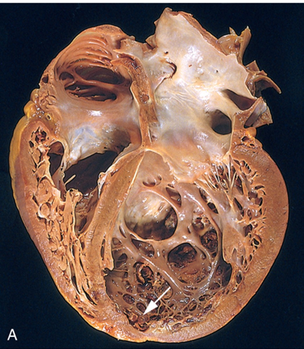 <p>dilated cardiomyopathy</p>