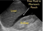 <p>Where is Morrison’s pouch?</p><p>*common spot for blood to accumulate</p>