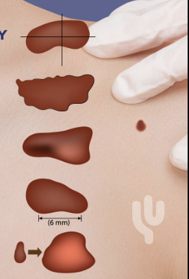 <p>What is the ABCD rule?</p>