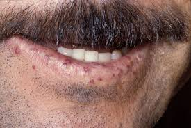 <p>PP: blanchable spots</p><p>E: vascular fragility<br>atriovenous malformations</p><p>CM: lips<br>PO mucosa<br>nasal septal mucosa<br>fingertips</p>