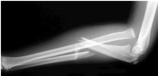 <p>What type of fracture is shown here?</p><p>-An ulnar shaft fracture with radial head dislocation, may need true elbow and wrist films </p>