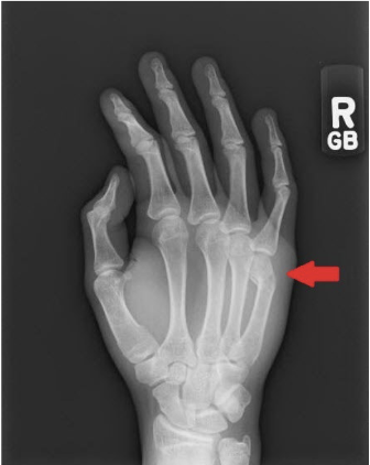 <ul><li><p>Fracture of distal fifth metacarpal</p></li><li><p>Results from punching someone or something</p></li></ul><p></p>