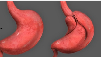 <p><strong>GERD: Severe or Frequent Symptoms or Erosive Esophagitis Treatment</strong></p><p>-___ → block proton pumps to prevent release of gastric acid</p><ul><li><p>Begin with standard dose of PPI once daily for _ weeks + lifestyle changes </p></li></ul><p>-Reserved for refractory cases → surgical and endoscopic therapy </p><ul><li><p>Laparoscopic _______ ___________</p></li><li><p>Thermocoagulation of LES </p></li><li><p>Suturing of LES </p></li></ul><p></p>