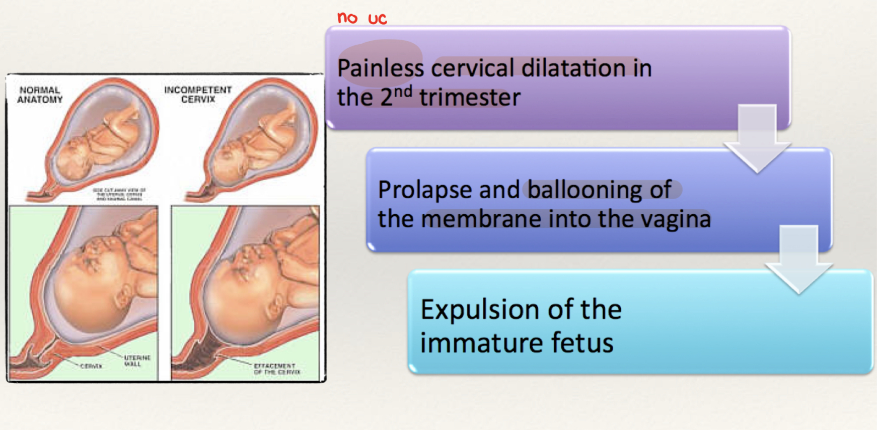 <p>Painless cervical dilatation in 2nd trimester </p>