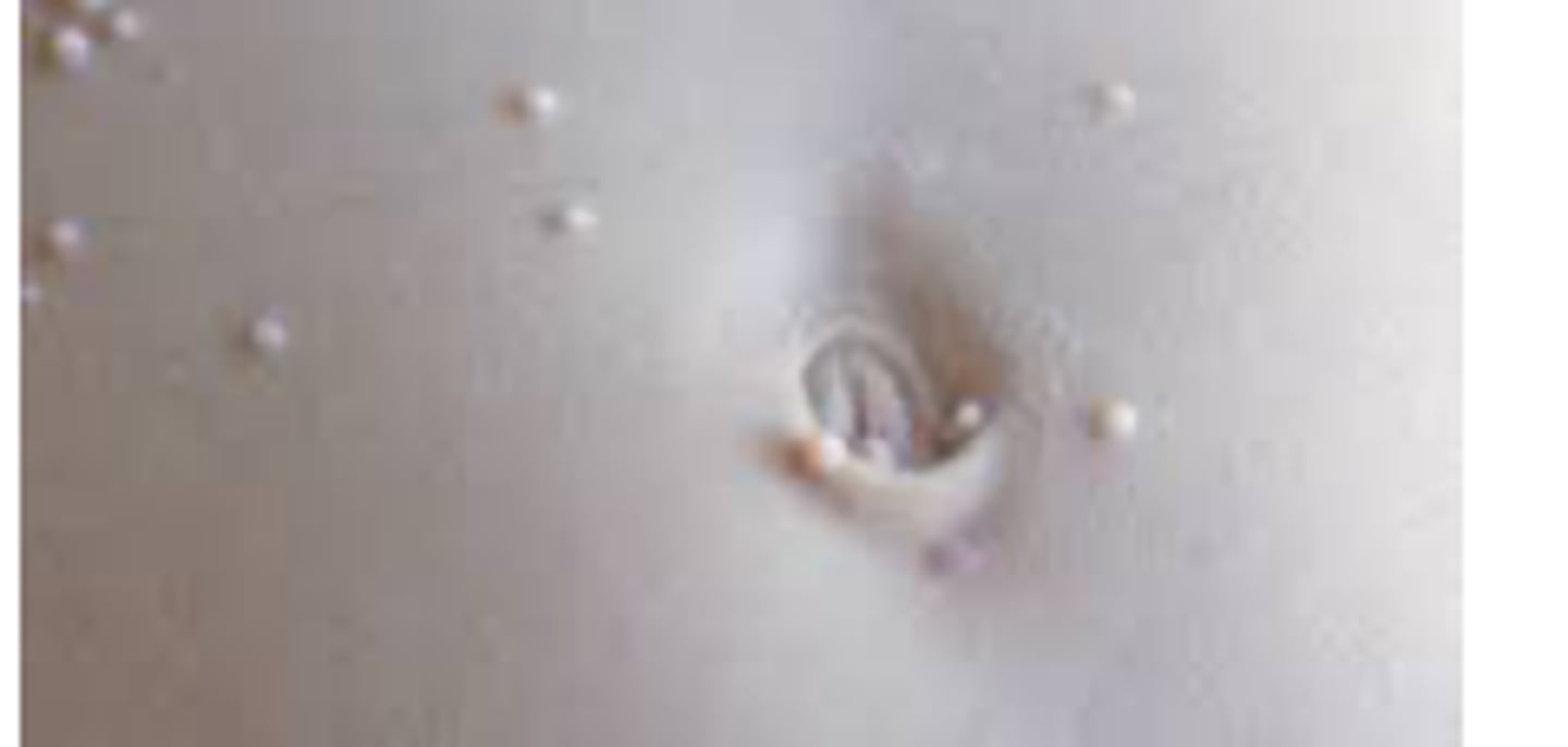 <p>aka warts D</p><p>resolves 6-18 mo</p>
