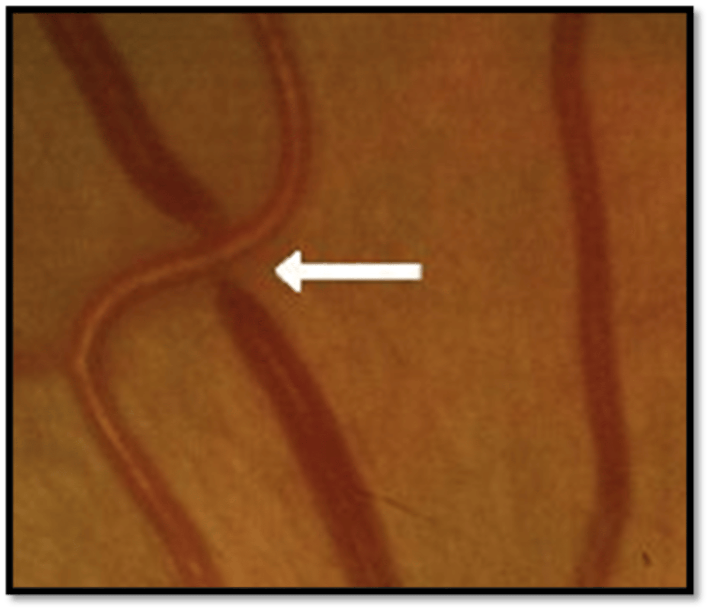<p>-Occurs at AV crossings</p><p>-Most common in superior temporal arcade</p><p>-Compression of the retinal vein at their common sheath causes venous nicking/banking, dilation, and tortuosity</p>
