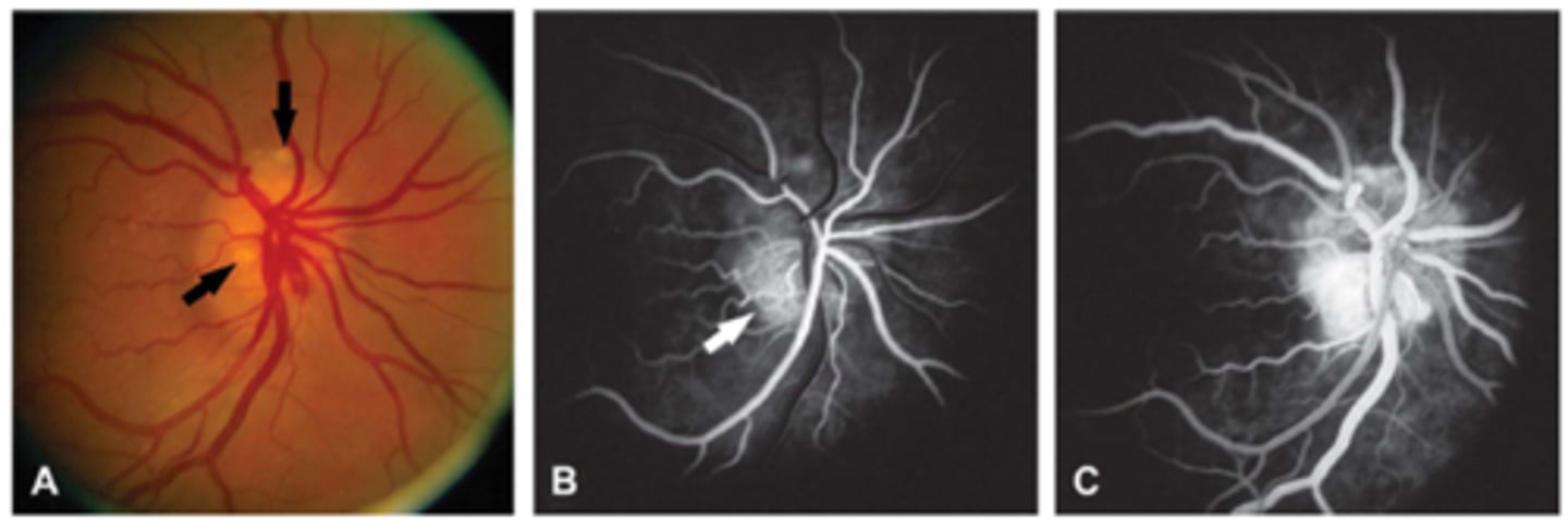 <p>early = edema leaks, drusen stain</p><p>late = edema leaks, drusen stain</p>