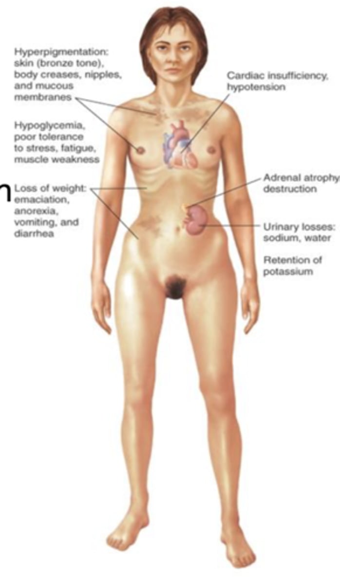 <p>anorexia and weight loss, fatigue and weakness, GI symptoms, myalgia and arthralgia, orthostatic hypotension, hyponatremia, hyperkalemia, hyper pigmentation, decreased blood volume</p>