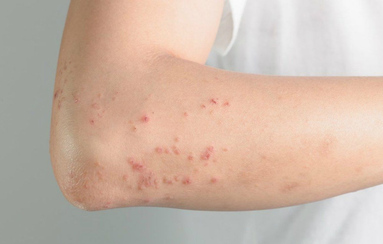 <p>measles (n)</p>