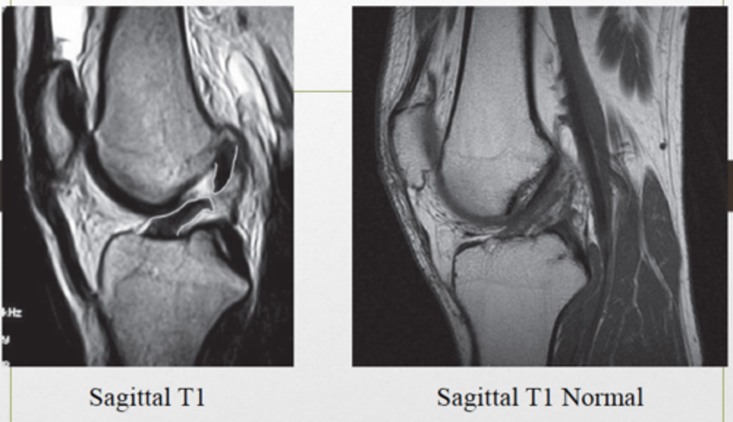 <p>tear of the anterior cruciate ligament</p><p>- caused by sudden stops, changes in direction or twisting injuries directly seen in sports</p><p>- can present with symptoms like popping sound, knee instability, swelling , or pain</p><p>- positive anterior drawer test will confirm</p>