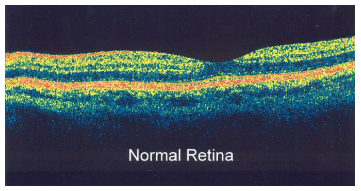 <p>OCT, non invasive, beam of near infra red light, detects reflected light, scattered removed with interferometry, 3d image of retina, map and measure thickness</p>