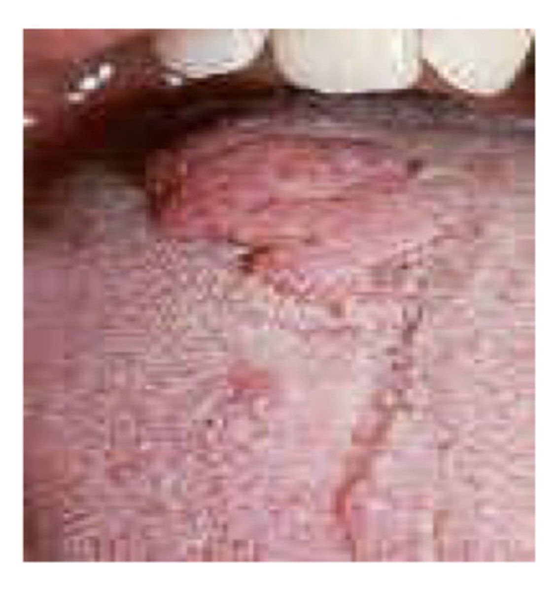 <p>Small or dilated vessels filled with lymph - almost colourless and may appear black if blood is in the lymph spaces - what am i?</p>