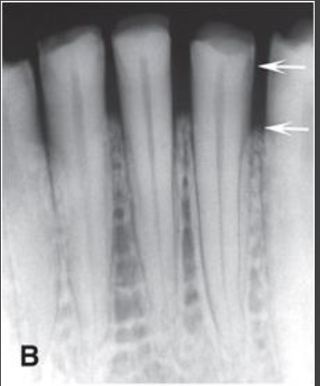 <p>Horizontal Bone Loss</p>
