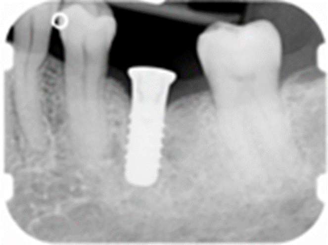 <p><span>What type of restorative replacement is shown for tooth # 19</span></p>