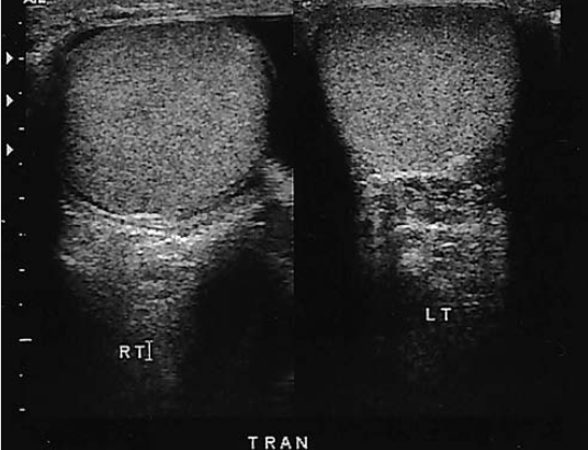 <p>a patient presents with left scrotal pain. He denies a fever or trauma. Which of the following abnormalities is most likely identified</p>
