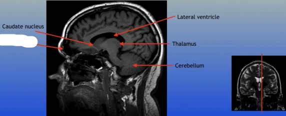 <p>A paired cavity located within the frontal bone, above the eyes, that plays a role in sinus drainage and resonance of the voice.</p>